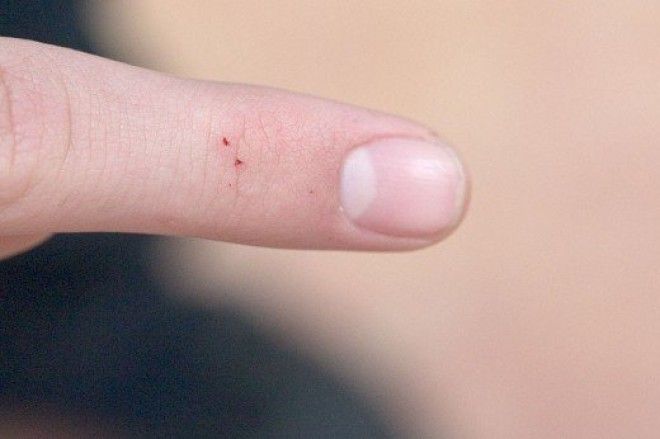 8 видов укусов насекомых о которых вы просто обязаны знать
