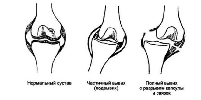 Первая помощь при вывихе: как выглядит пострадавший сустав
